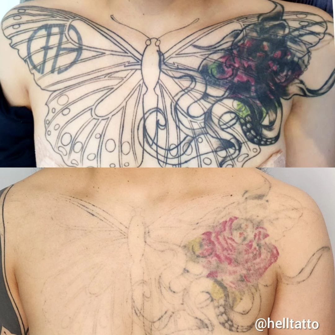 Remoção de tatuagem é segura