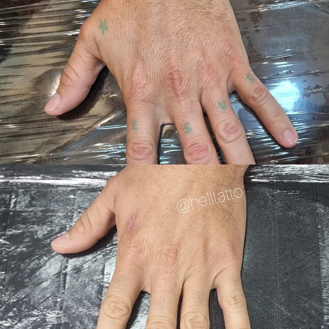 Remoção de tatuagem no dedo