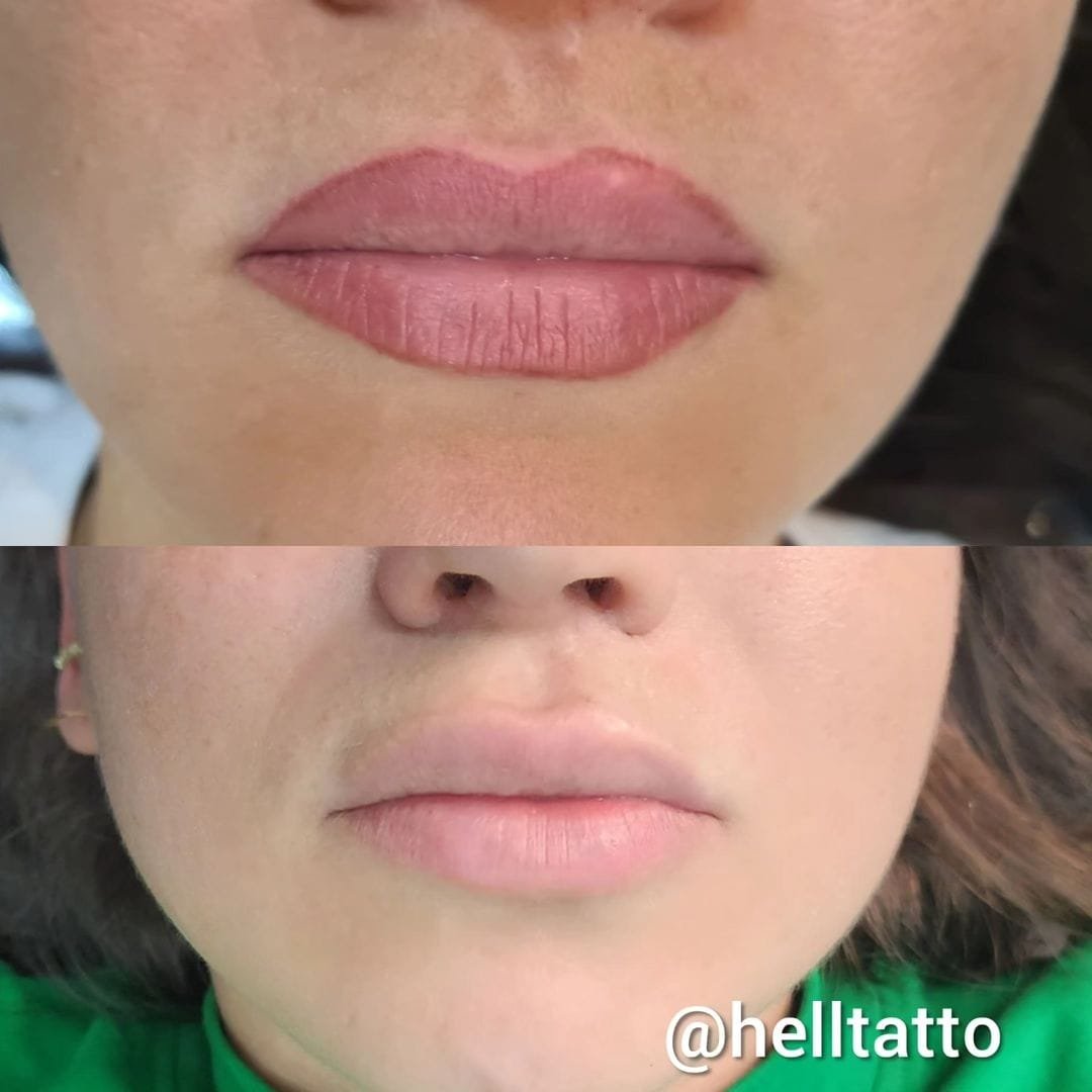 Remoção Micropigmentação labial