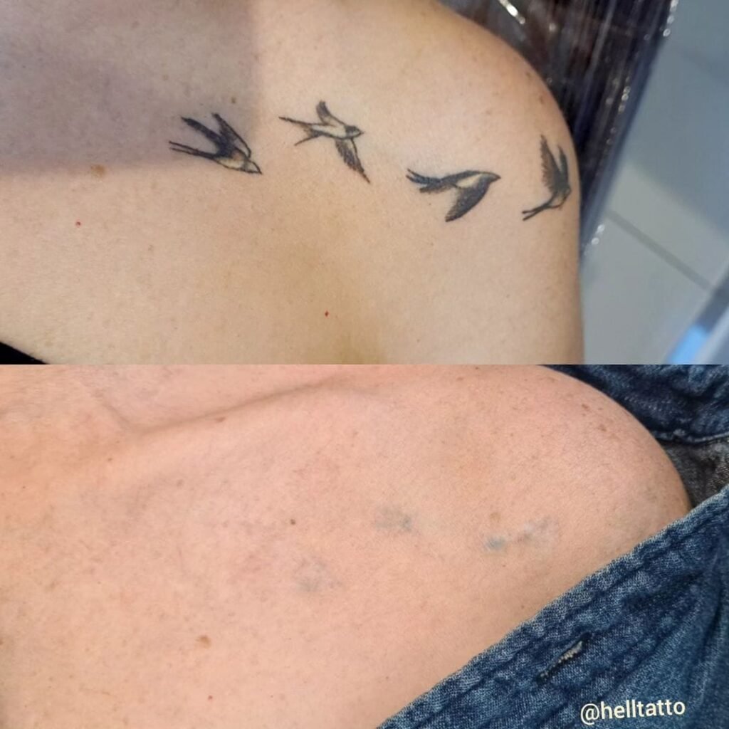 remoção de tatuagem remover tudo