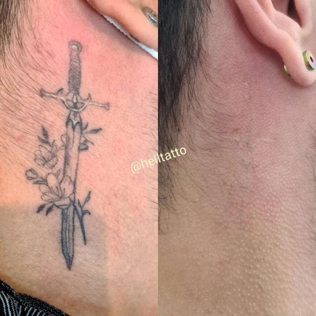 Remoção de tatuagem