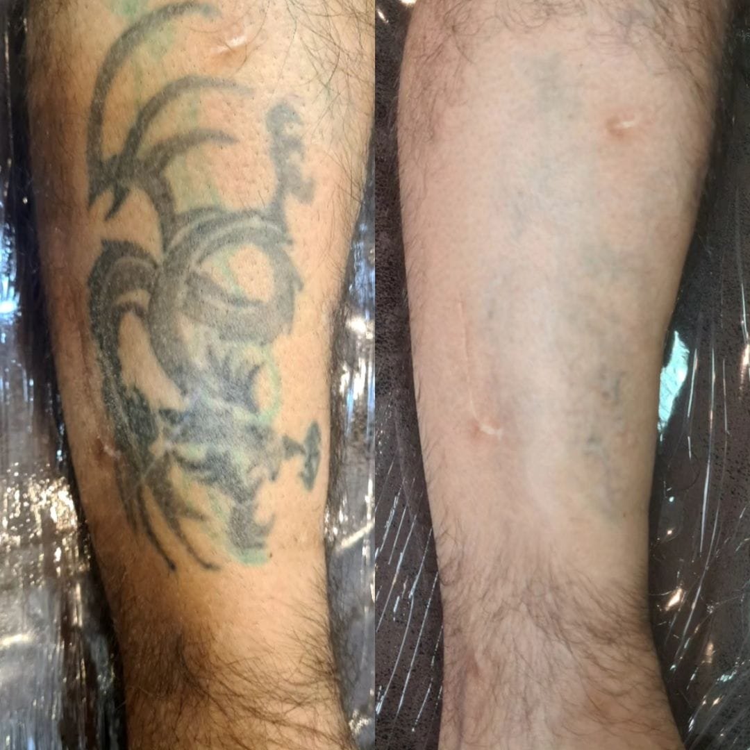 Remoção de tatuagem deixa cicatriz